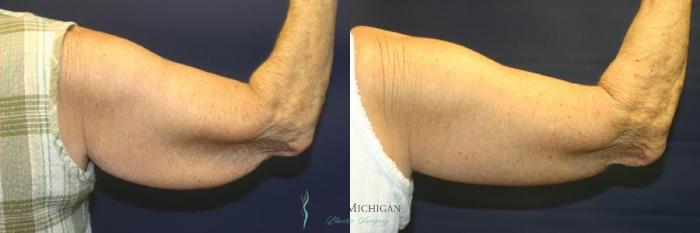 Before & After Arm Lift Case 8700 View #3 View in Kalamazoo & Grand Rapids, Michigan