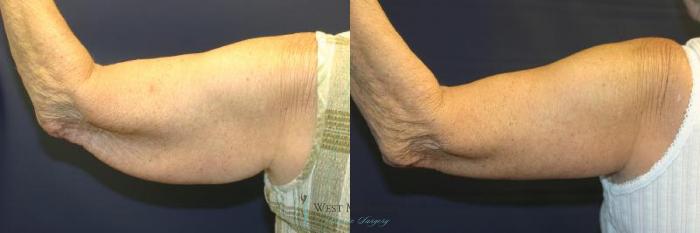 Before & After Arm Lift Case 8700 View #4 View in Kalamazoo & Grand Rapids, Michigan