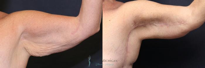 Before & After Arm Lift Case 8701 View #1 View in Portage, Kalamazoo, Battle Creek, Michigan