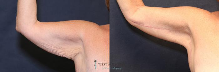 Before & After Arm Lift Case 8701 View #2 View in Kalamazoo & Grand Rapids, Michigan