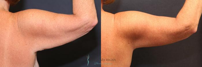 Before & After Arm Lift Case 8701 View #3 View in Kalamazoo & Grand Rapids, Michigan