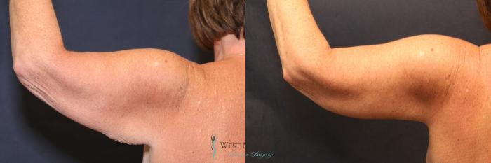Before & After Arm Lift Case 8701 View #4 View in Kalamazoo & Grand Rapids, Michigan