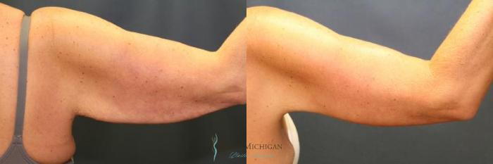 Before & After Arm Lift Case 8932 View #3 View in Portage, Kalamazoo, Battle Creek, Michigan