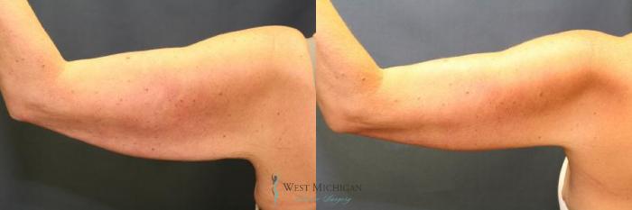 Before & After Arm Lift Case 8932 View #4 View in Portage, Kalamazoo, Battle Creek, Michigan