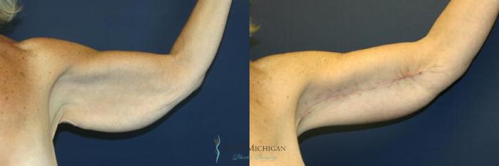 Before & After Arm Lift Case 8934 View #1 View in Kalamazoo & Grand Rapids, Michigan