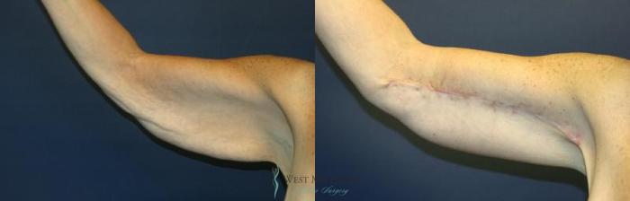 Before & After Arm Lift Case 8934 View #2 View in Kalamazoo & Grand Rapids, Michigan