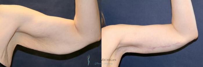 Before & After Arm Lift Case 9010 View #1 View in Portage, Kalamazoo, Battle Creek, Michigan