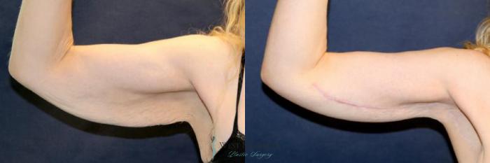 Before & After Arm Lift Case 9010 View #2 View in Kalamazoo & Grand Rapids, Michigan