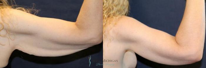 Before & After Arm Lift Case 9010 View #3 View in Kalamazoo & Grand Rapids, Michigan