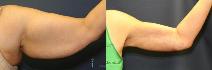 Before & After Arm Lift Case 9011 View #1 View in Portage, Kalamazoo, Battle Creek, Michigan