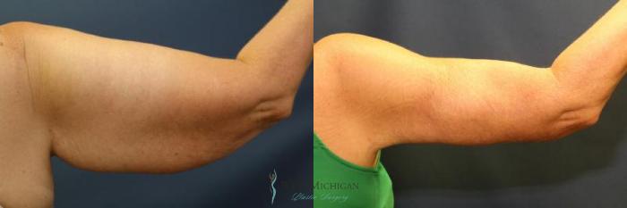 Before & After Arm Lift Case 9011 View #3 View in Portage, Kalamazoo, Battle Creek, Michigan