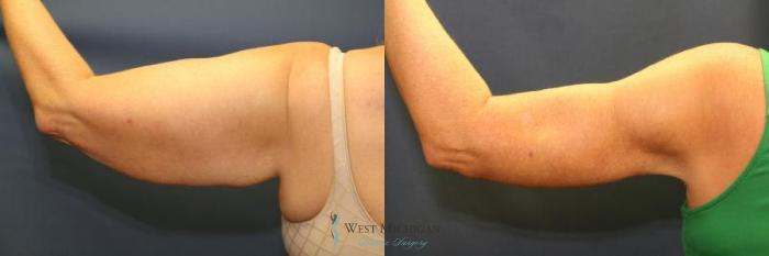 Before & After Arm Lift Case 9011 View #4 View in Portage, Kalamazoo, Battle Creek, Michigan