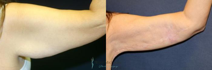 Before & After Arm Lift Case 9012 View #1 View in Kalamazoo & Grand Rapids, Michigan