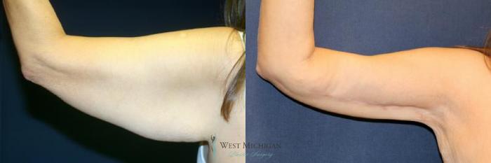 Before & After Arm Lift Case 9012 View #2 View in Kalamazoo & Grand Rapids, Michigan