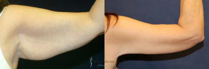 Before & After Arm Lift Case 9012 View #3 View in Kalamazoo & Grand Rapids, Michigan