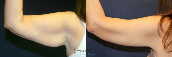 Before & After Arm Lift Case 9012 View #4 View in Kalamazoo & Grand Rapids, Michigan