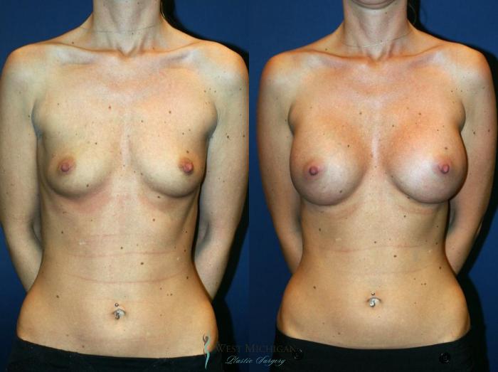 Before & After Breast Augmentation Case 8718 View #1 View in Portage, Kalamazoo, Battle Creek, Michigan