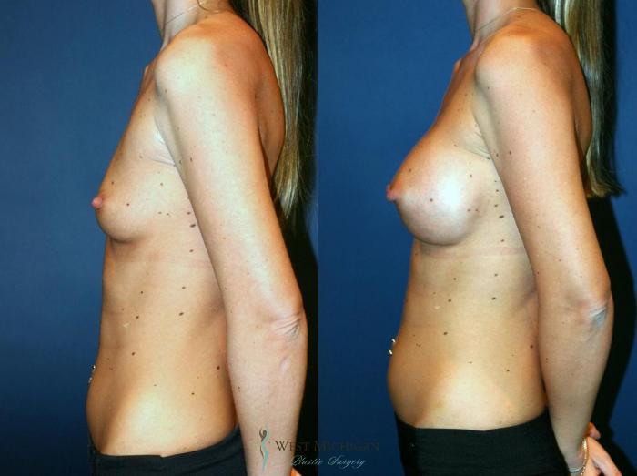 Before & After Breast Augmentation Case 8718 View #2 View in Portage, Kalamazoo, Battle Creek, Michigan