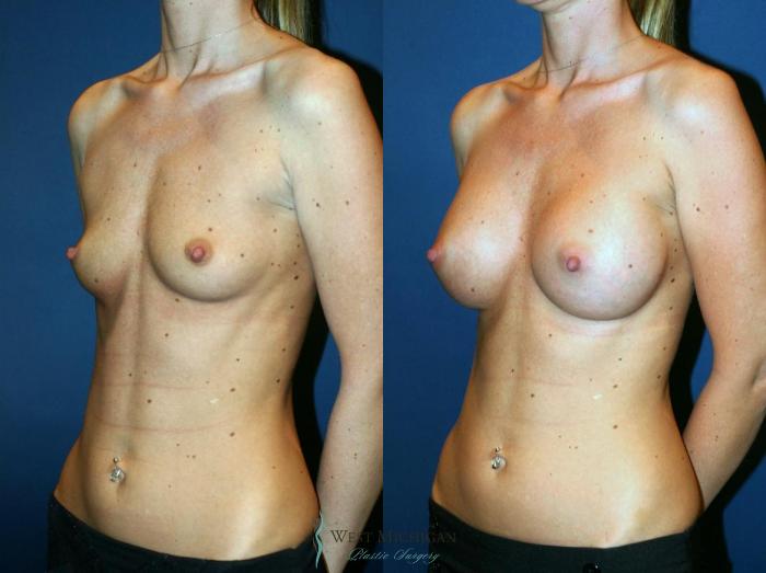 Before & After Breast Augmentation Case 8718 View #3 View in Portage, Kalamazoo, Battle Creek, Michigan