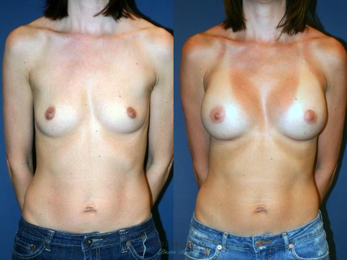Before & After Breast Augmentation Case 8898 View #1 View in Portage, Kalamazoo, Battle Creek, Michigan