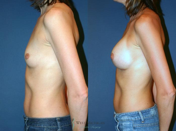 Before & After Breast Augmentation Case 8898 View #2 View in Portage, Kalamazoo, Battle Creek, Michigan