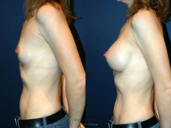 Before & After Breast Augmentation Case 8899 View #2 View in Portage, Kalamazoo, Battle Creek, Michigan
