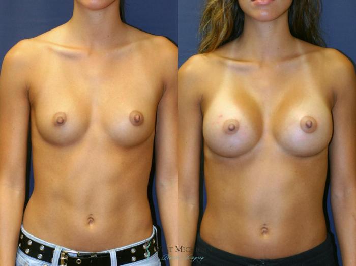 Before & After Breast Augmentation Case 8900 View #1 View in Kalamazoo & Grand Rapids, Michigan