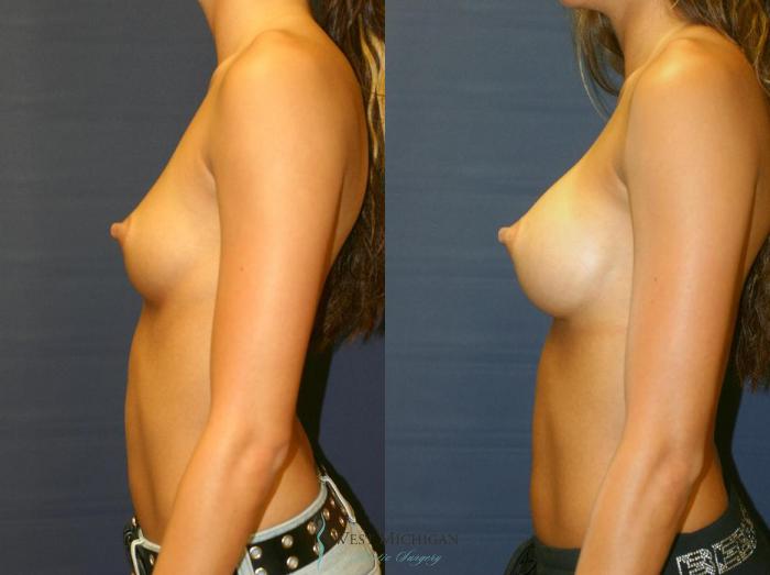 Before & After Breast Augmentation Case 8900 View #2 View in Portage, Kalamazoo, Battle Creek, Michigan