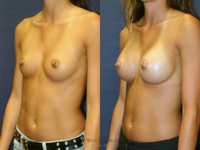 Before & After Breast Augmentation Case 8900 View #3 View in Kalamazoo & Grand Rapids, Michigan