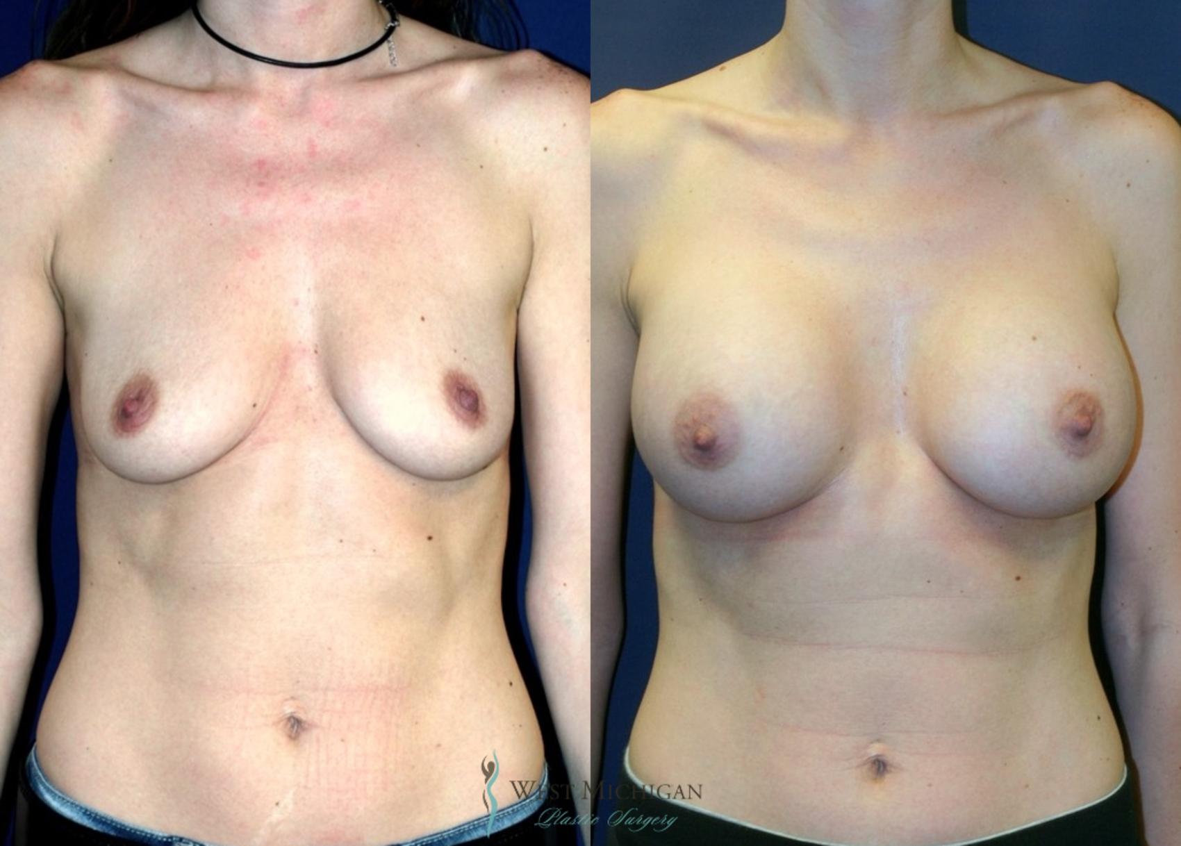 Before & After Breast Augmentation Case 8901 View #1 View in Portage, Kalamazoo, Battle Creek, Michigan