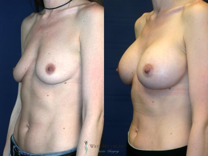 Before & After Breast Augmentation Case 8901 View #3 View in Kalamazoo & Grand Rapids, Michigan