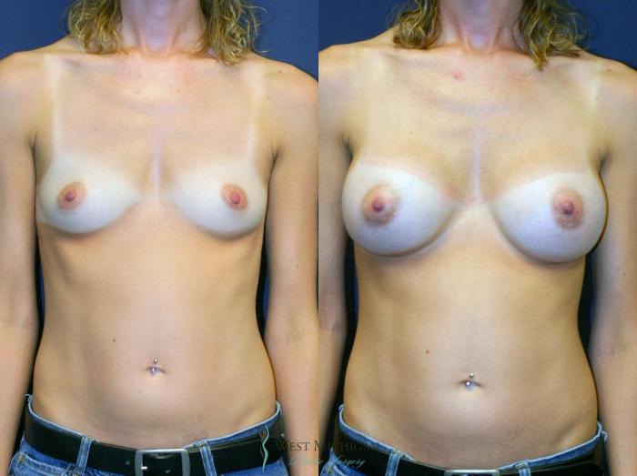 Before & After Breast Augmentation Case 8902 View #1 View in Portage, Kalamazoo, Battle Creek, Michigan