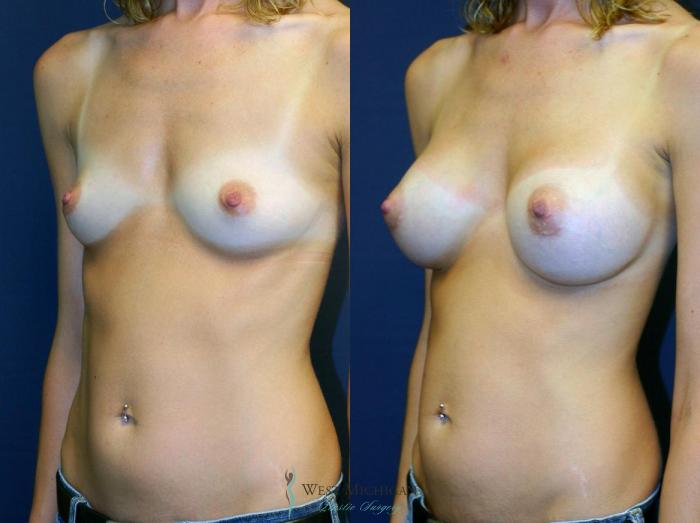 Before & After Breast Augmentation Case 8902 View #3 View in Portage, Kalamazoo, Battle Creek, Michigan