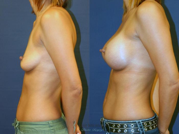 Before & After Breast Augmentation Case 8903 View #1 View in Portage, Kalamazoo, Battle Creek, Michigan