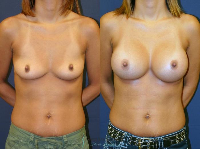 Before & After Breast Augmentation Case 8903 View #2 View in Portage, Kalamazoo, Battle Creek, Michigan