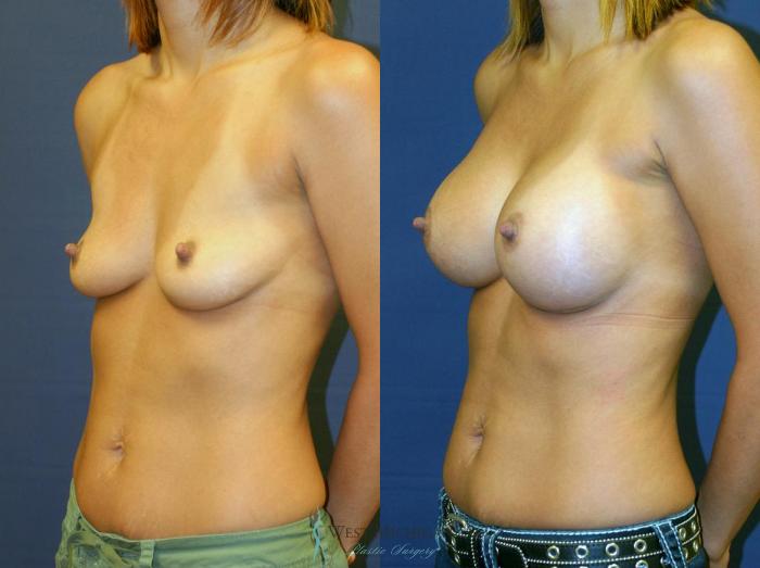 Before & After Breast Augmentation Case 8903 View #3 View in Portage, Kalamazoo, Battle Creek, Michigan