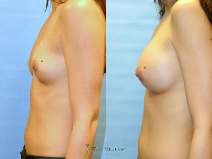 Before & After Breast Augmentation Case 8904 View #2 View in Portage, Kalamazoo, Battle Creek, Michigan