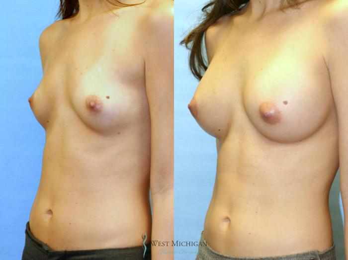 Before & After Breast Augmentation Case 8904 View #3 View in Portage, Kalamazoo, Battle Creek, Michigan