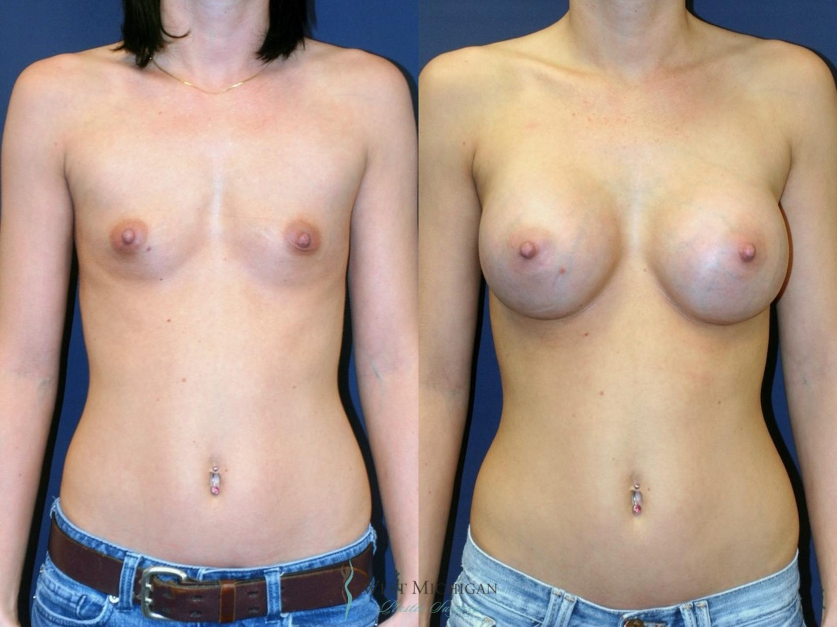 Before & After Breast Augmentation Case 8905 View #1 View in Portage, Kalamazoo, Battle Creek, Michigan