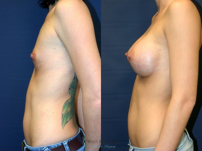 Before & After Breast Augmentation Case 8905 View #2 View in Portage, Kalamazoo, Battle Creek, Michigan