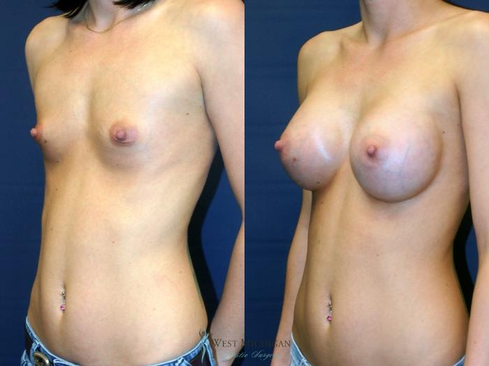 Before & After Breast Augmentation Case 8905 View #3 View in Portage, Kalamazoo, Battle Creek, Michigan