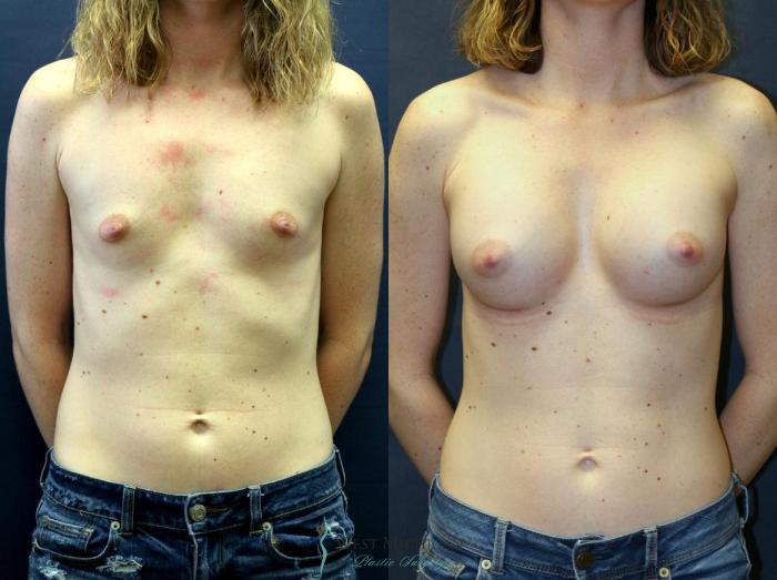 Before & After Breast Augmentation Case 8906 View #1 View in Portage, Kalamazoo, Battle Creek, Michigan