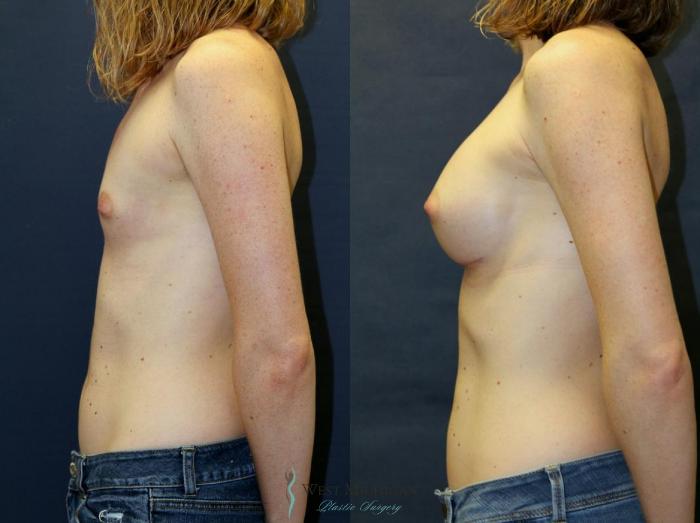 Before & After Breast Augmentation Case 8906 View #2 View in Portage, Kalamazoo, Battle Creek, Michigan