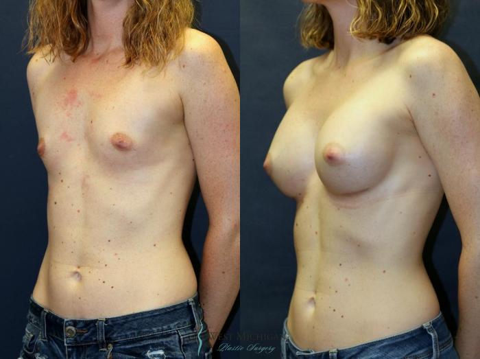 Before & After Breast Augmentation Case 8906 View #3 View in Portage, Kalamazoo, Battle Creek, Michigan