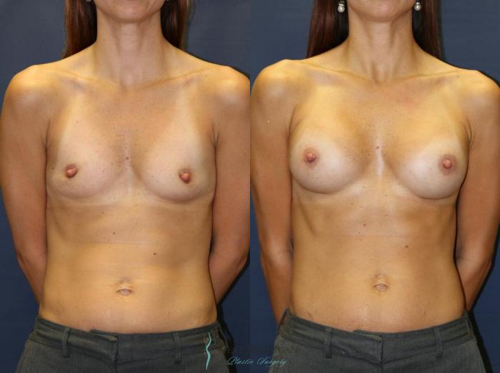 Before & After Breast Augmentation Case 8933 View #1 View in Portage, Kalamazoo, Battle Creek, Michigan