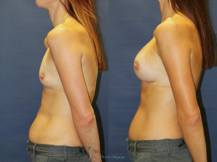 Before & After Breast Augmentation Case 8933 View #2 View in Portage, Kalamazoo, Battle Creek, Michigan