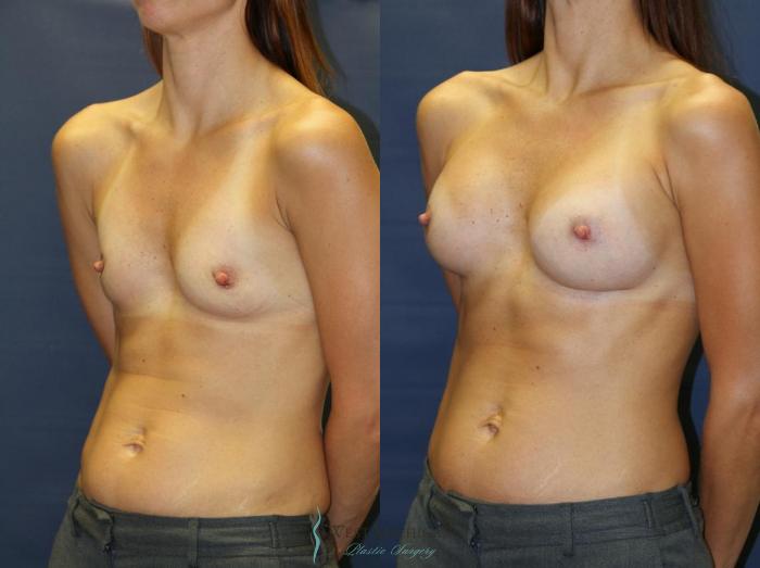 Before & After Breast Augmentation Case 8933 View #3 View in Portage, Kalamazoo, Battle Creek, Michigan