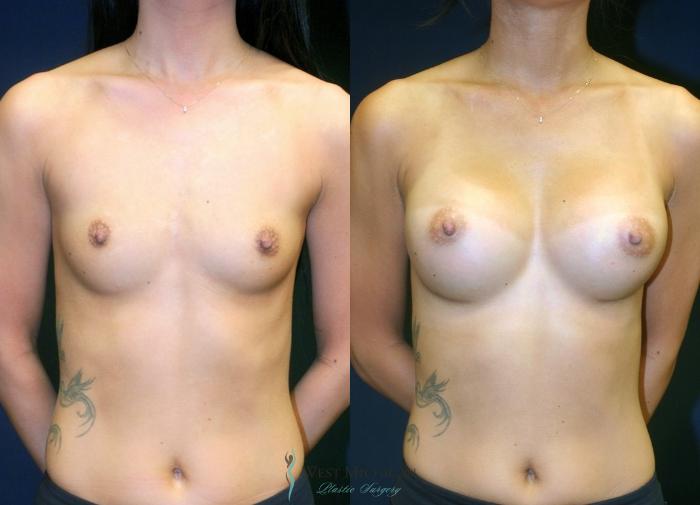 Before & After Breast Augmentation Case 9066 Front View in Portage, Kalamazoo, Battle Creek, Michigan