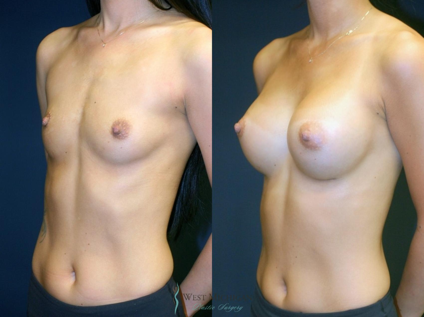 Before & After Breast Augmentation Case 9066 View #1 View in Kalamazoo & Grand Rapids, Michigan