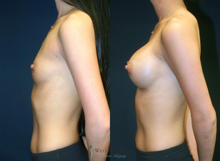 Before & After Breast Augmentation Case 9066 View #2 View in Portage, Kalamazoo, Battle Creek, Michigan